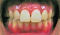 開咬:矯正治療後