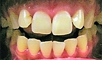 開咬:矯正治療前