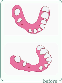 歯牙欠損施術前イラスト