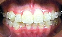 乱杭歯:矯正治療後