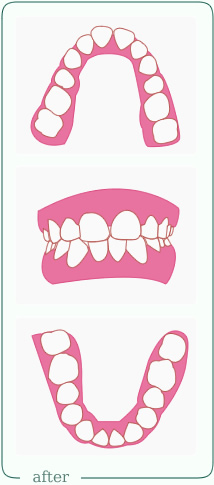 叢生治療後イラスト