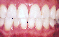 ホワイトニング症例1後（約4週間）
