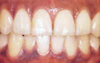 ホワイトニング症例1前