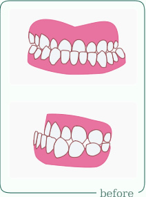 受け口治療前イラスト