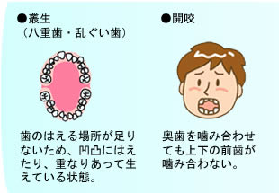 ・八重歯/乱ぐい歯（歯が凹凸にはえたり重なりあって生えている状態）・開咬（奥歯を噛み合わせても上下の前歯が噛み合わない）