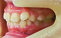 受け口:ムーシールドによる矯正治療後