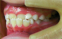 受け口:ムーシールドによる矯正治療前