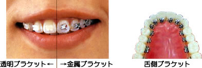 ブラケットの種類と舌側のブラケット