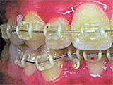 ワイヤーを利用した治療。透明ブラケット（ワイヤー装着後）